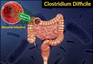 Clostridium Difficile Infection - Symptoms, Treatment, Causes